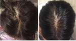 before after alopecia