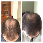 before after hair loss