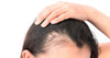 How To Stop Alopecia From Spreading?
