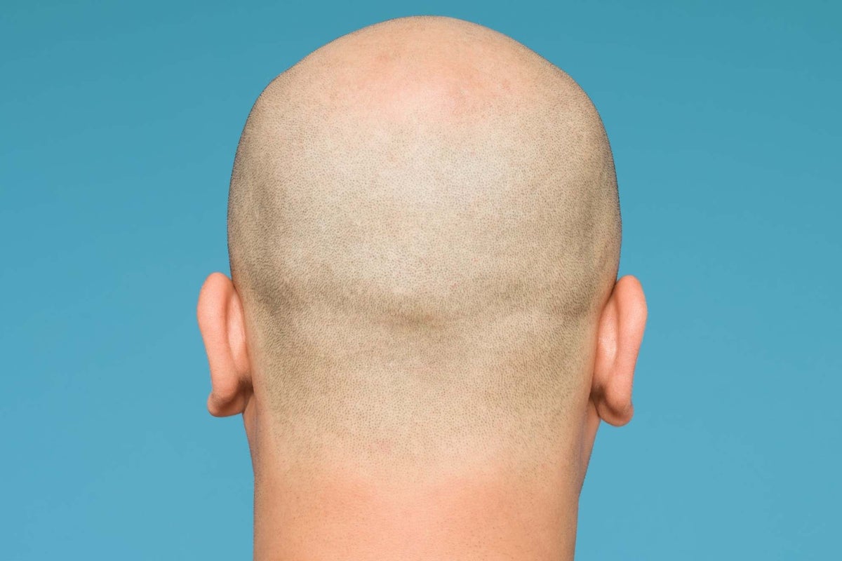 What is Pattern Hair Loss?