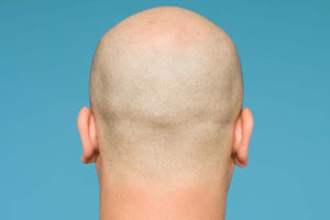 What is Pattern Hair Loss?