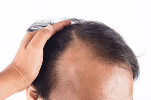 How to Regrow Hair on Bald Spots Fast?