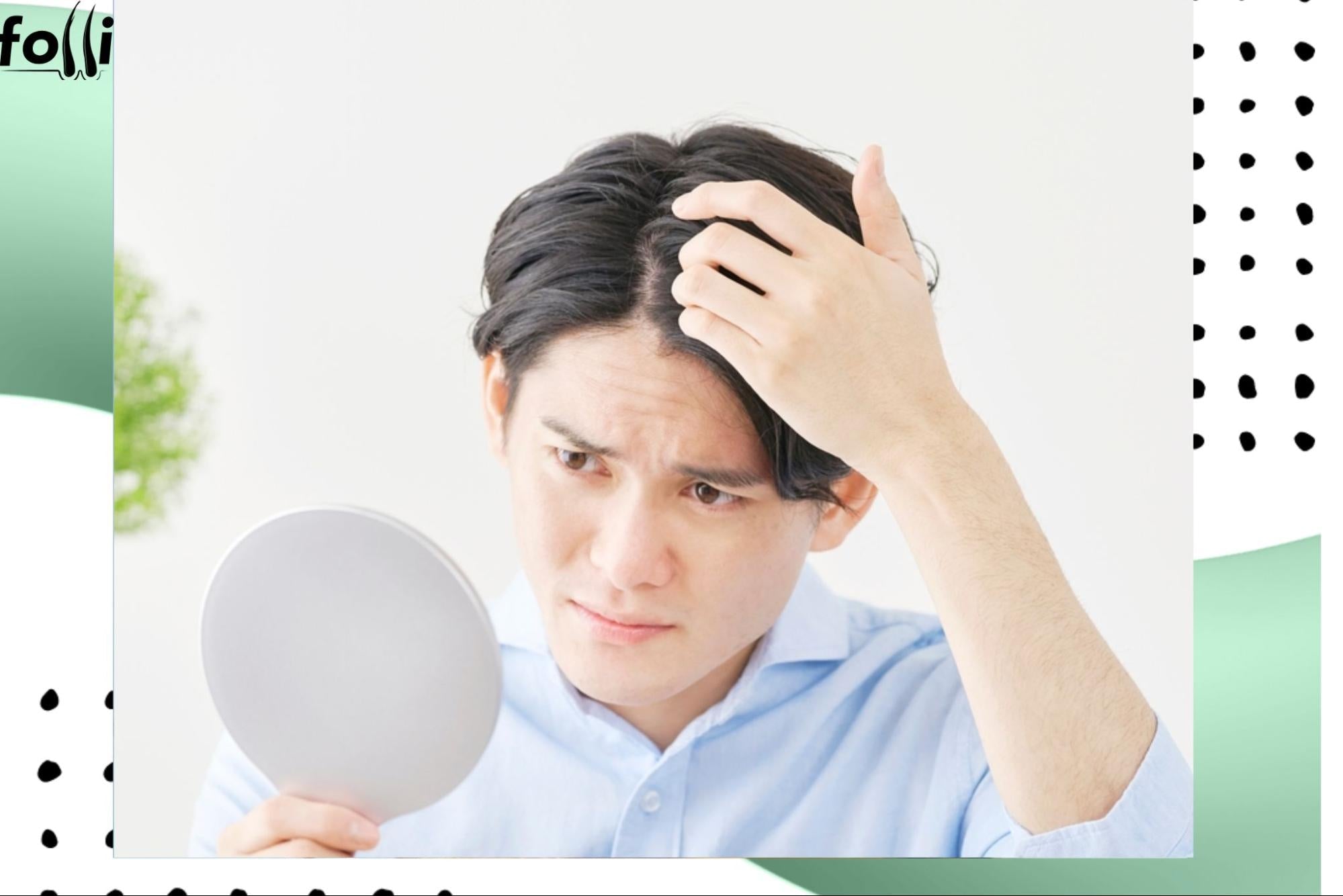Male Pattern Baldness: Proven Solutions & Growth Support