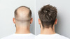 Hair Transplant Before and After: Results & Safer Hair Care Options