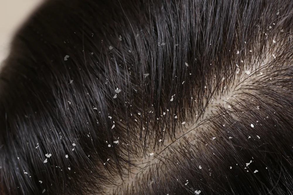What is the Best Cure for Dandruff? Top Treatments and Remedies of 2025