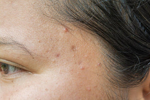 Pimples on Scalp: Causes, Treatment & Prevention Tips