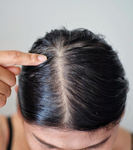 Causes of Oily Scalp: Understanding the Root of the Problem