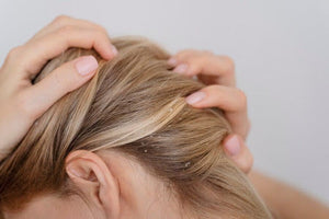 Acnes on Scalp: Surprising Causes & Proven Solutions Revealed
