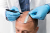 Hair Growth Surgery Cost: What You Should Know Before Investing