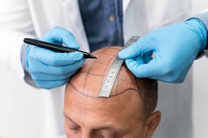 Hair Growth Surgery Cost: What You Should Know Before Investing