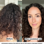 Before after Hair Growth Treatment Bundle