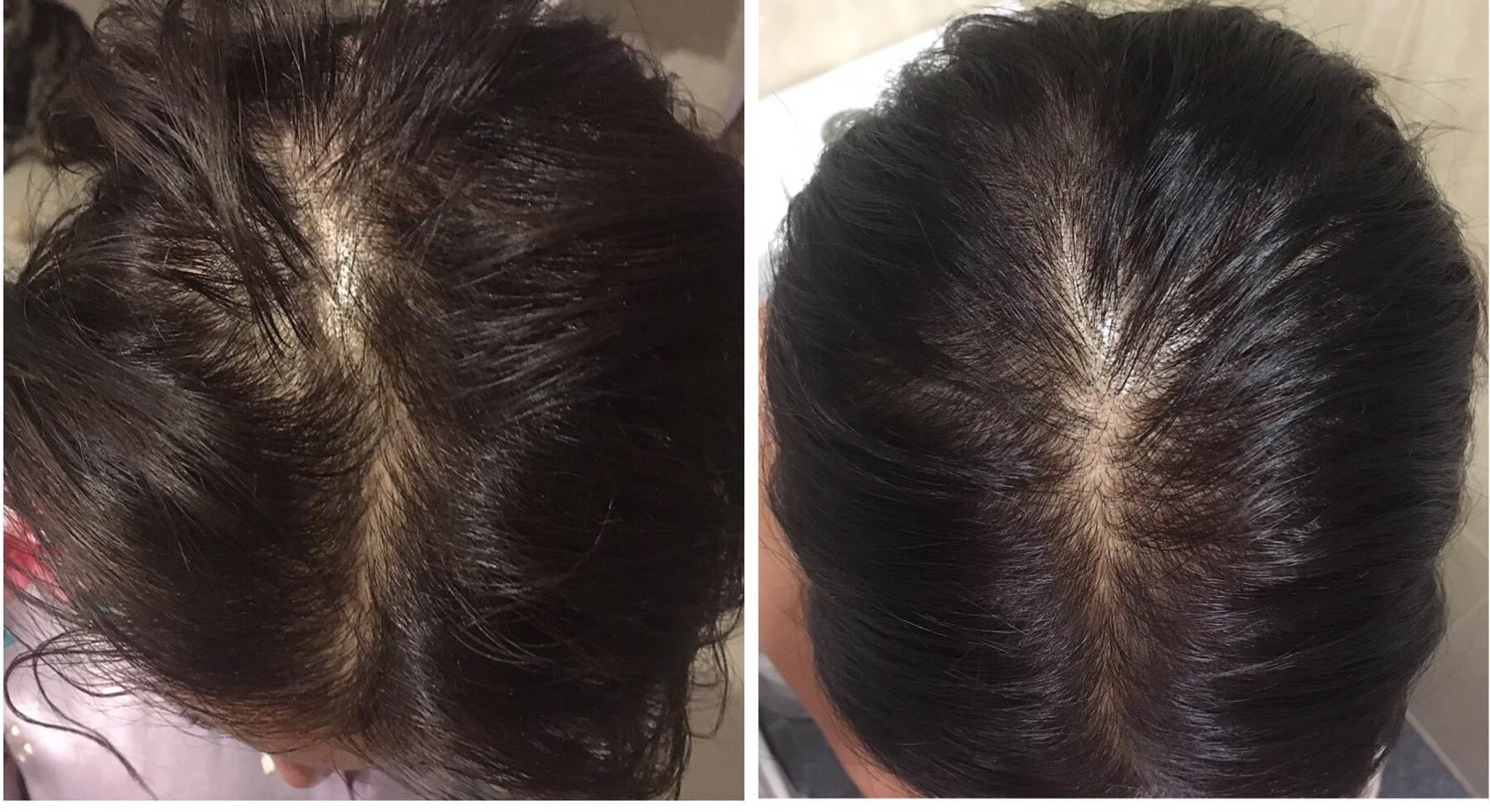 before after alopecia 