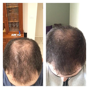 before after hair loss 